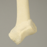Femur with 20 Degree Distal Valgus Deformity