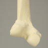 Femur with 20 Degree Distal Valgus Deformity