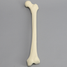 Femur with Hypoplastic Condyle Defect