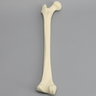 Femur with Hypoplastic Condyle Defect