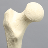 Femur with Hypoplastic Condyle Defect