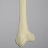 Femur with Distal Valgus Deformity and Rotation