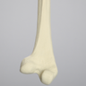 Femur with Distal Valgus Deformity and Rotation