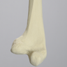 Femur with 25 Degree Distal Valgus Deformity