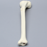 Tibia with Malunion and 25 Degree Valgus Defect
