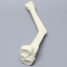 Tibia with Malunion and 20 Degree Procurvatum