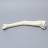 Tibia with Malunion and 20 Degree Procurvatum