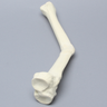 Tibia with Malunion and 20 Degree Procurvatum
