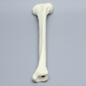 Tibia with Varus and Internal Rotation