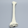 Tibia with Varus and Internal Rotation