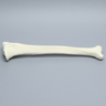 Tibia with Varus and Internal Rotation