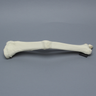 Tibia and Fibula with Malunions, Varus, and Procurvatum