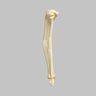 Tibia and Fibula with Malunions, Varus, and Procurvatum