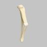 Tibia and Fibula with Malunions, Varus, and Procurvatum