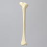 Tibia with Blount's Disease and Varus Deformities, Solid Foam