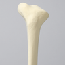 Tibia with Blount's Disease and Varus Deformities, Solid Foam