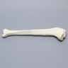 Tibia with Midshaft Malunion and Blount's Disease