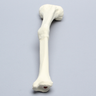 Tibia with Malunion and 17 Degree Plane Defect