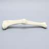 Tibia with Malunion and 17 Degree Plane Defect