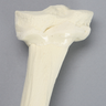Tibia with Double Level Angulation