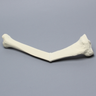 Tibia with Malunion and 25 Degree Procurvatum