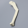 Tibia with Malunion and 25 Degree Procurvatum