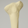 Tibia with Proximal and Distal Deformity