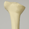 Tibia with Proximal and Distal Deformity