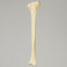 Tibia with Proximal and Distal Deformity