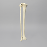 Tibia and Fibula with Varus Defect, Solid Foam
