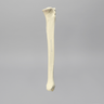 Tibia and Fibula with Varus Defect, Solid Foam
