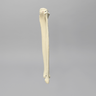 Tibia and Fibula with Varus Defect, Solid Foam