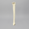 Tibia and Fibula with Varus Defect, Solid Foam