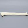 Tibia with 30 Degrees Varus Defect