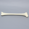 Tibia with 30 Degrees Varus Defect