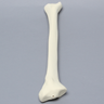 Tibia with 30 Degrees Varus Defect