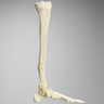 Foot and Ankle with Distal Malunion and Rotation