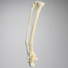 Foot and Ankle with Distal Malunion and Rotation