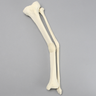 Tibia and Fibula with Malunions and 25º Varus Defect