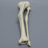 Tibia and Fibula with Malunions and Plane Defect