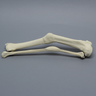 Tibia and Fibula with Malunions and Plane Defect