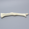 Tibia and Fibula with Malunions and 10º Varus Defect