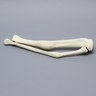 Tibia and Fibula with Malunions and 10º Varus Defect