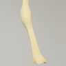 Tibia with Midshaft Malunion and 10º Varus Defect