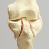 Knee with Bicondylar and Oblique Fractures of the Tibia, Full Length