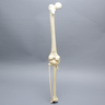 Knee with Femoral Butterfly and Tibial Plateau Fracture, Full Length