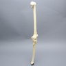 Knee with Femoral Butterfly and Tibial Plateau Fracture, Full Length