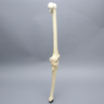 Knee with Femoral Butterfly and Tibial Plateau Fracture, Full Length