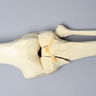 Leg with Plateau Fracture, Full Length