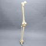 Leg with Plateau Fracture, Full Length